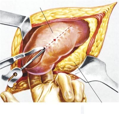 Nefroptosi definizione e significato medico Corriere Salute