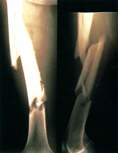 Frattura definizione e significato medico Corriere Salute