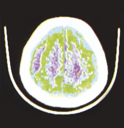 Ematoma definizione e ultime news Corriere Salute