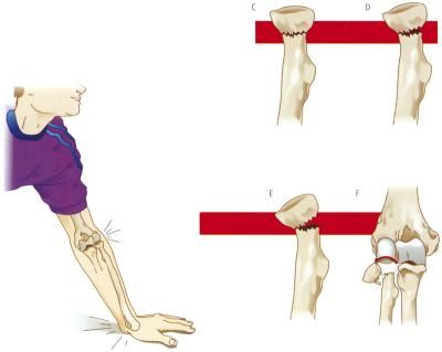 Frattura definizione e significato medico Corriere Salute