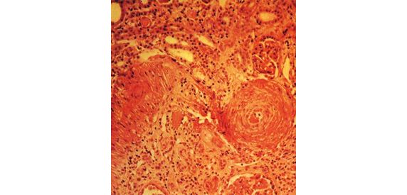 Nefroangiosclerosi definizione e significato medico Corriere Salute