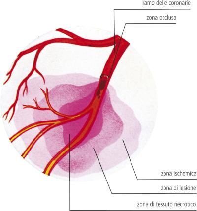 Infarto Definizione E Significato Medico Corriere Salute