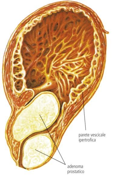 Prostatite Definizione E Significato Medico Corriere Salute